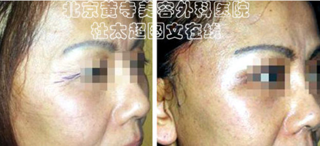 鱼尾纹怎么祛除最好