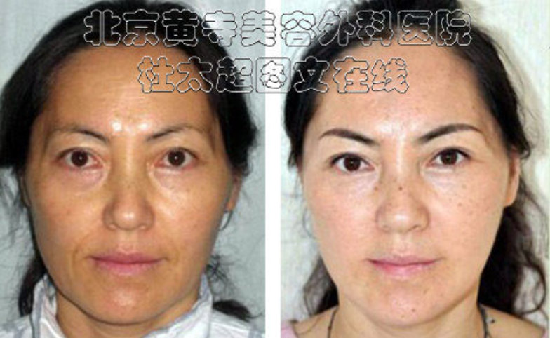 额纹去除的方法