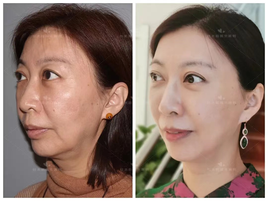 什么是小切口拉皮，和传统拉皮有什么区别？  