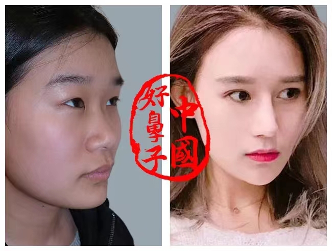 这类人群不适合做鼻子！