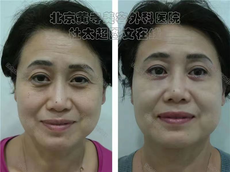 什么是眼袋？卧蚕，泪沟如何分辨？