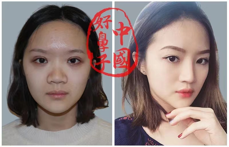 宽鼻缩窄怎么才能做更精致？