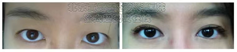 双眼皮手术类型那么多，到底该如何选择？