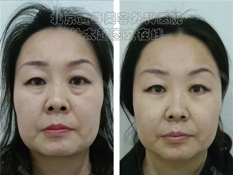 眼袋出现不祛除可以吗？