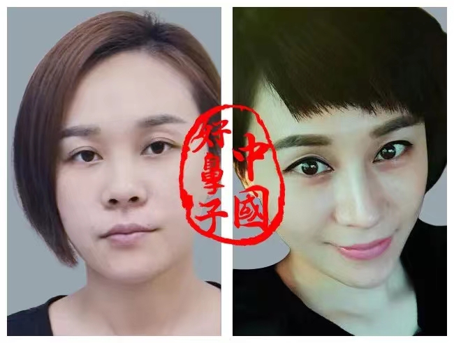 隆鼻后，老了会怎样？