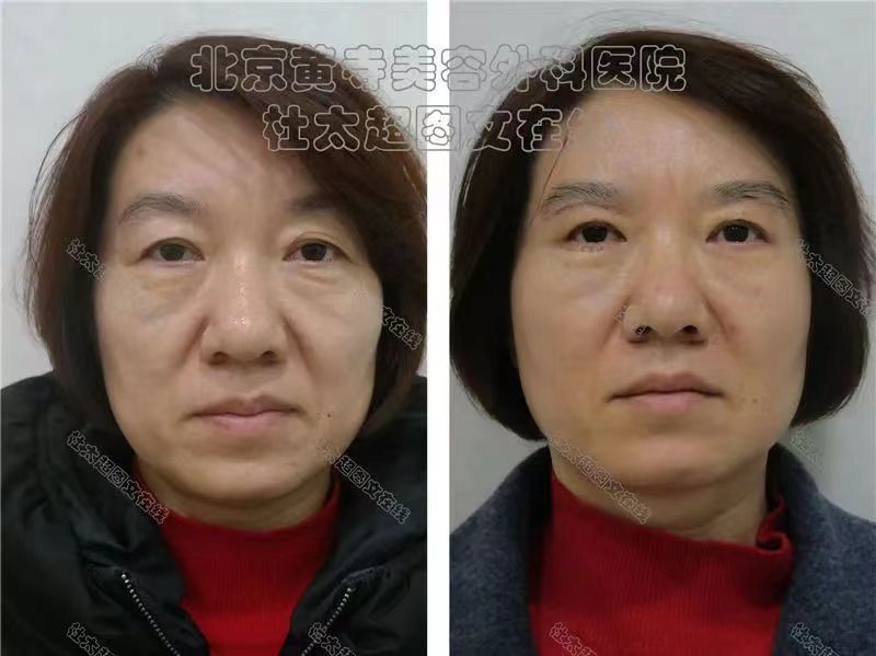 提眉、祛眼袋手术您有了解吗？