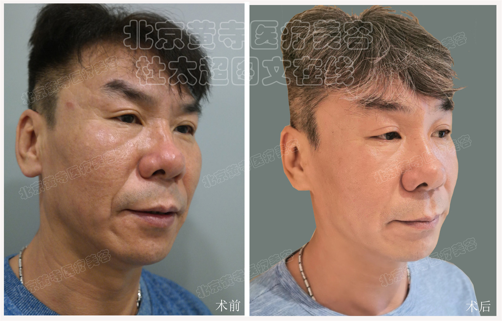 求美者53岁，小切口中下面部提升，额纹，川字纹去除，术后2年