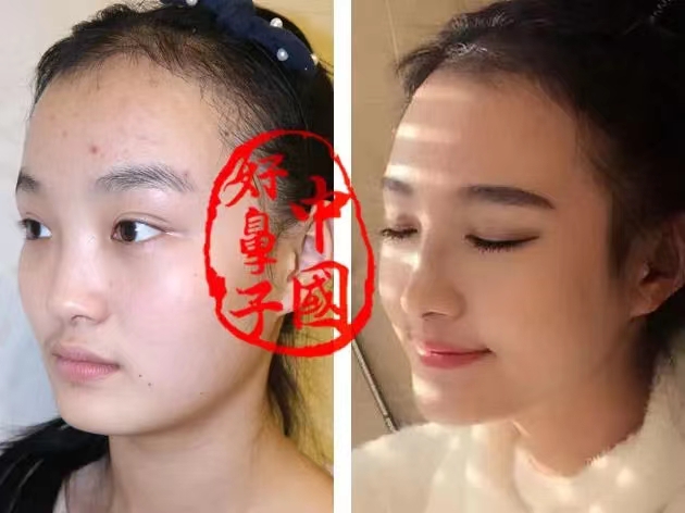 凸显细节的鼻小柱到底有多重要？