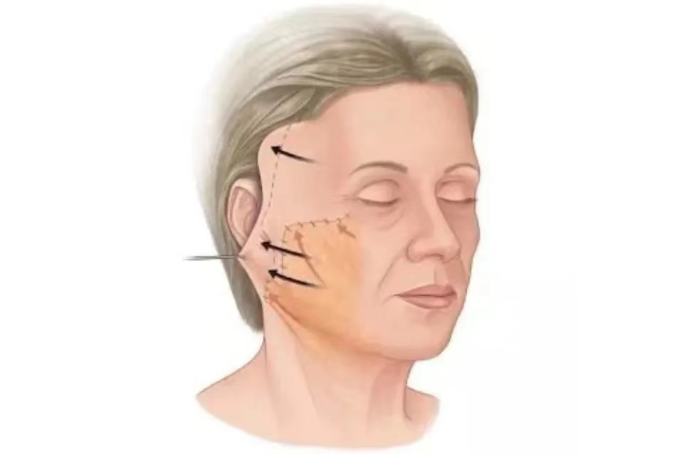 小拉皮常说的“筋膜层”到底是什么？