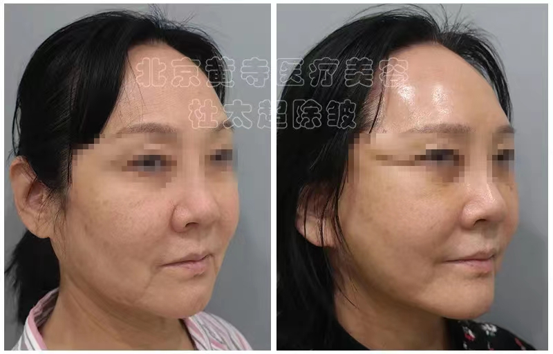 拉皮紧肤不是说说而已！