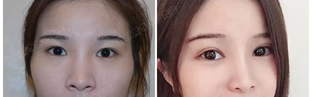 双眼皮手术前后要注意什么？