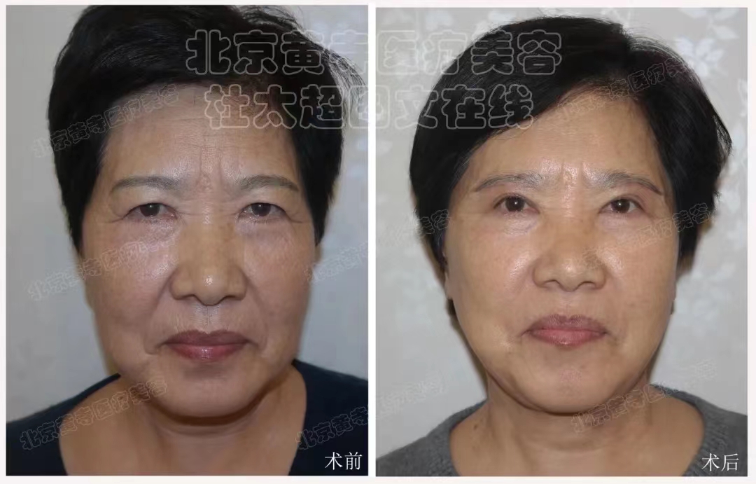 caw多点小切口提升详解