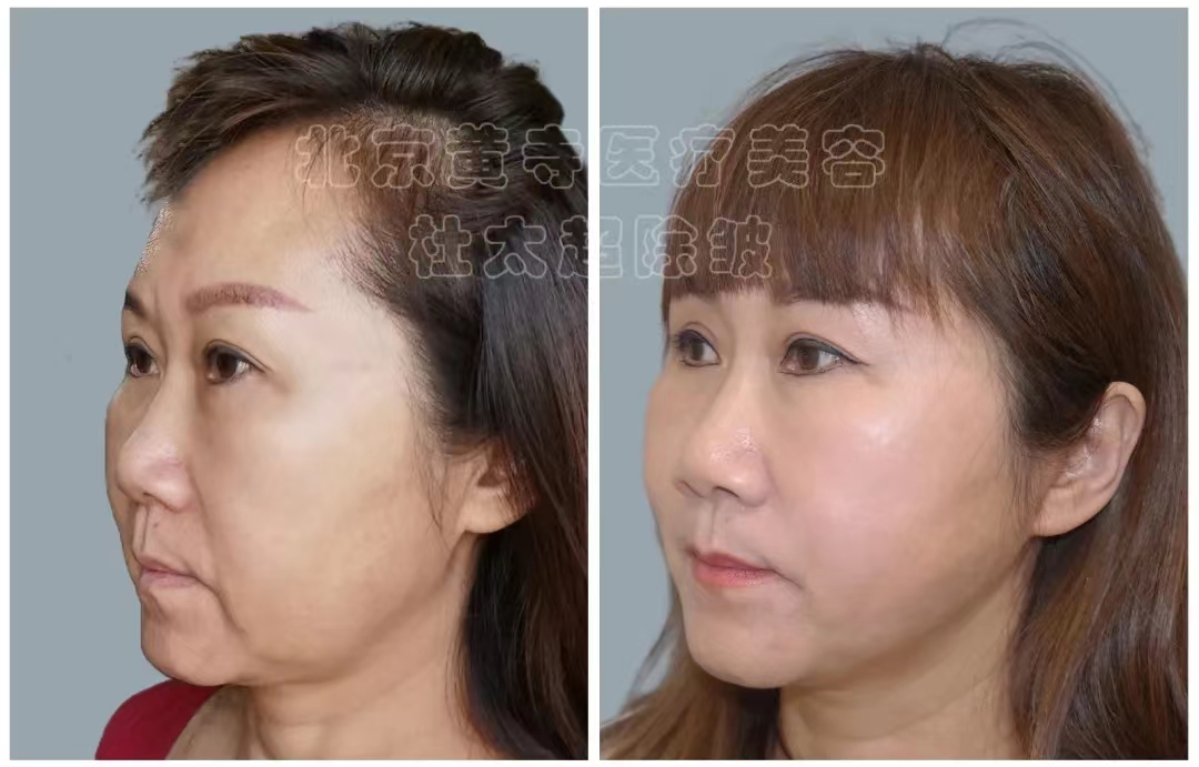 面部老化不仅显老还显脸大！