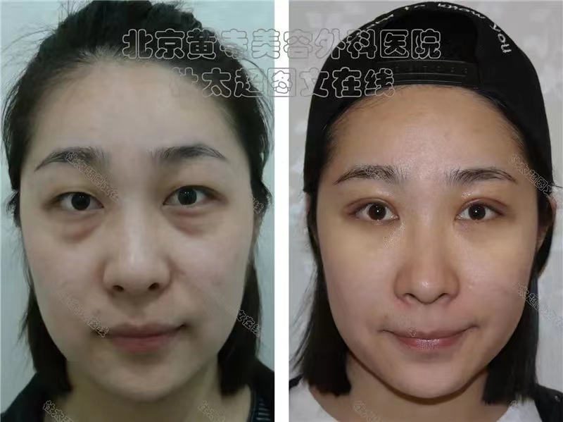 眼袋改善的常见方式！