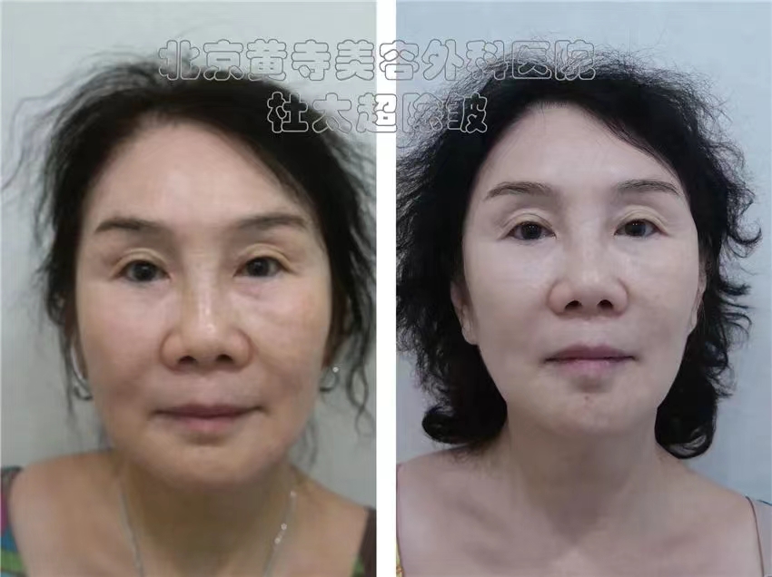 caw小切口拉皮适合哪些人群？