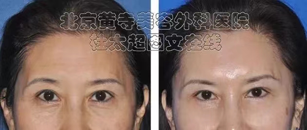 最恼人的眼下纹这样改善! 最恼人的眼下纹这样改善!