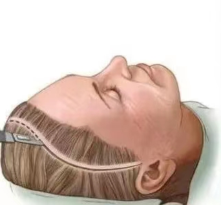 做了热玛吉、线雕，还是逃不过皮肤松垂！