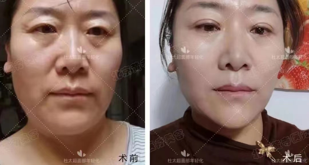 做了热玛吉、线雕，还是逃不过皮肤松垂！