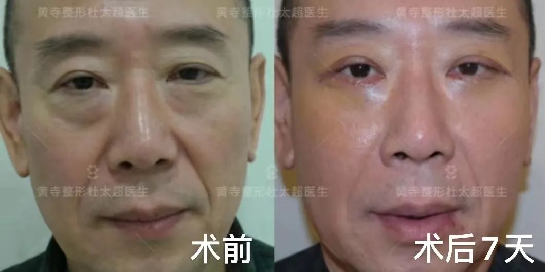 眼袋的形成原因及常见的处理方式 眼袋的形成原因及常见的处理方式