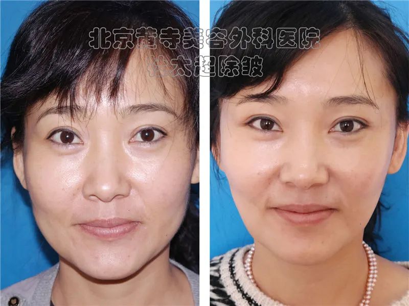 面部老化怎么办?如何打造“耐造脸” 面部老化怎么办?如何打造“耐造脸”