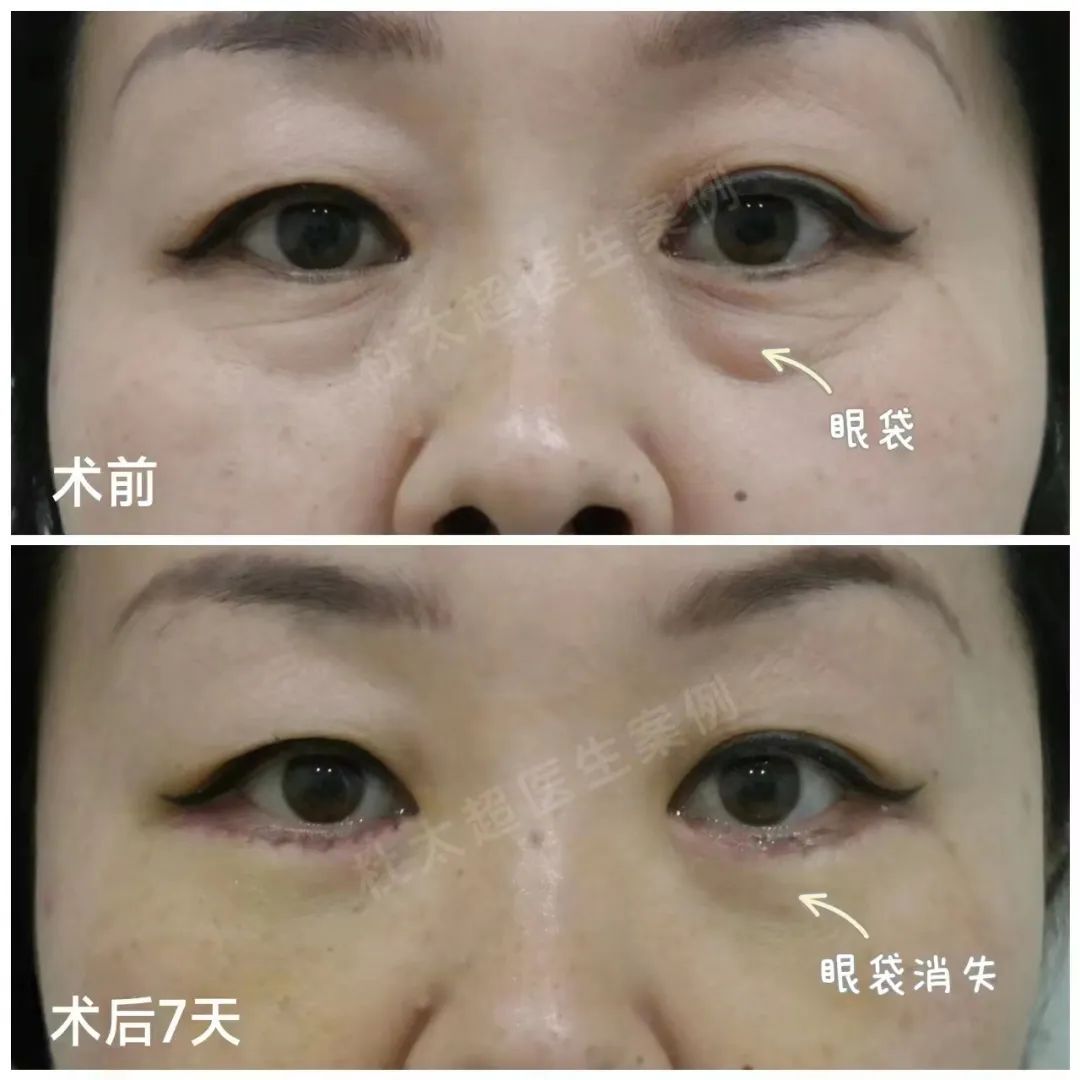 祛眼袋手术可能会出现什么问题呢？