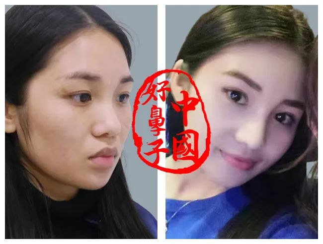 3分钟带你了解歪鼻整形美容术