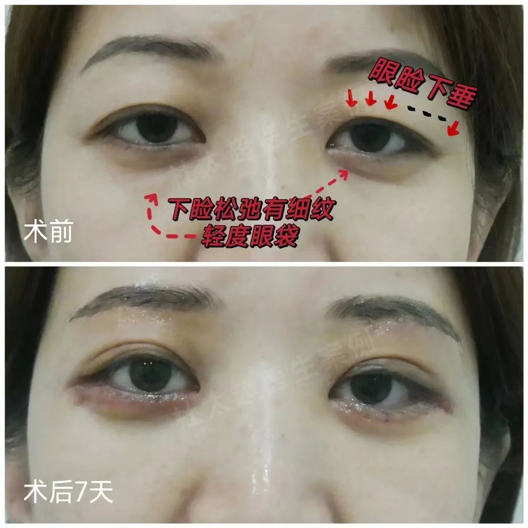 我才这么年轻，怎么眼皮都松弛了...