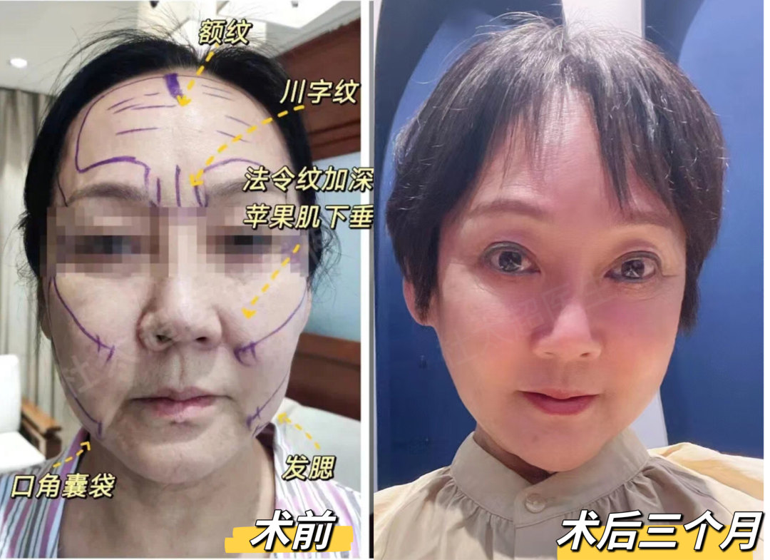 面部衰老如何治疗？来看看她的效果吧...