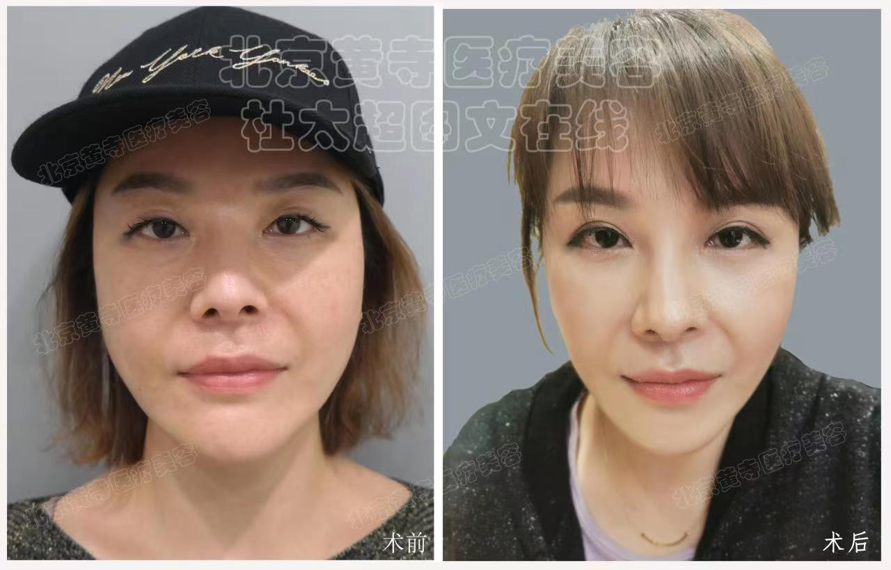 求美者50岁，小切口中下面部提升