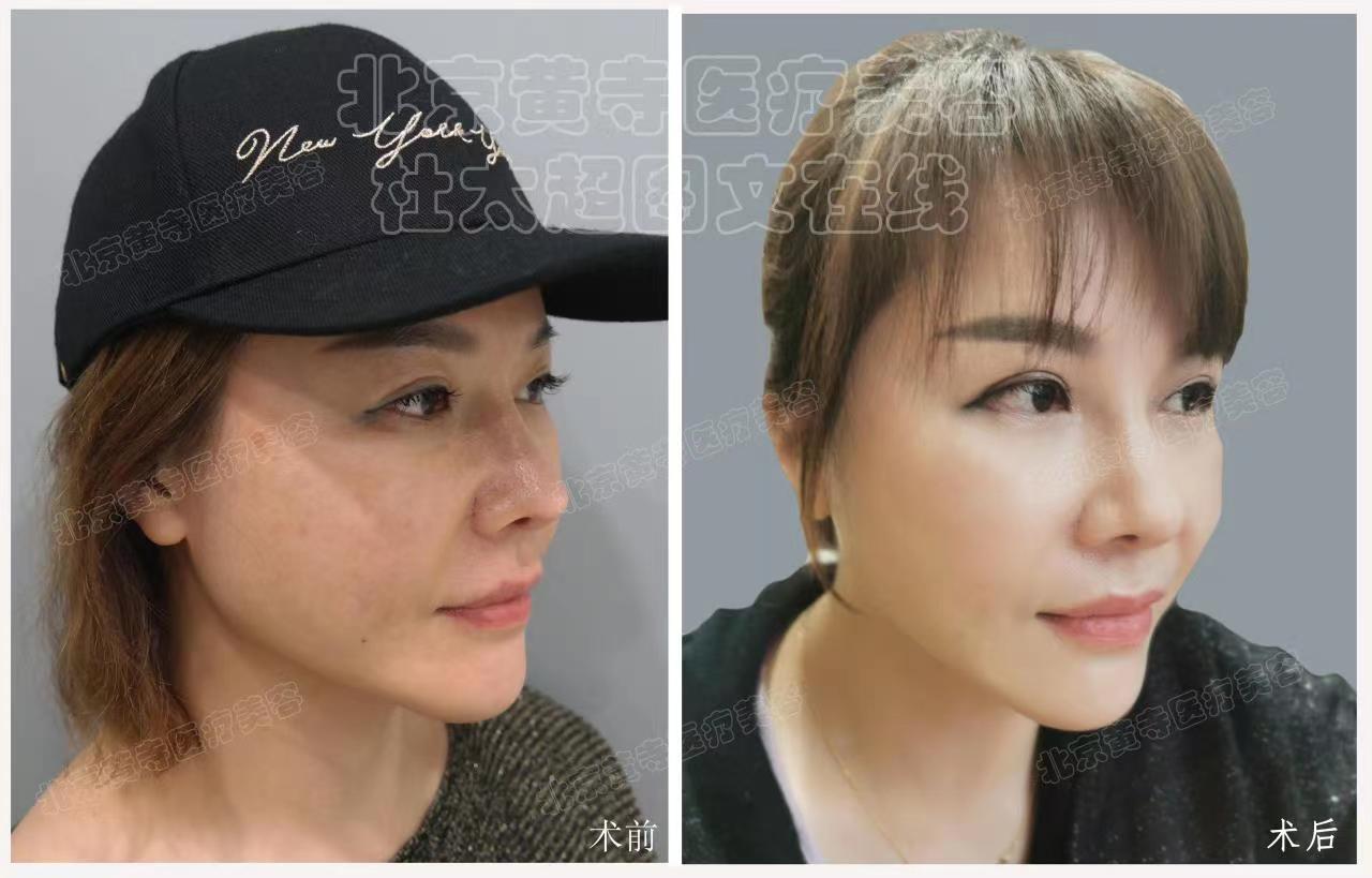 求美者50岁，小切口中下面部提升