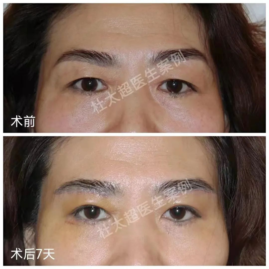 眼皮松弛的大部分是哪些人呢？