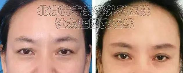 眉毛下垂,太让人显老,这样整…… 眉毛下垂,太让人显老,这样整……