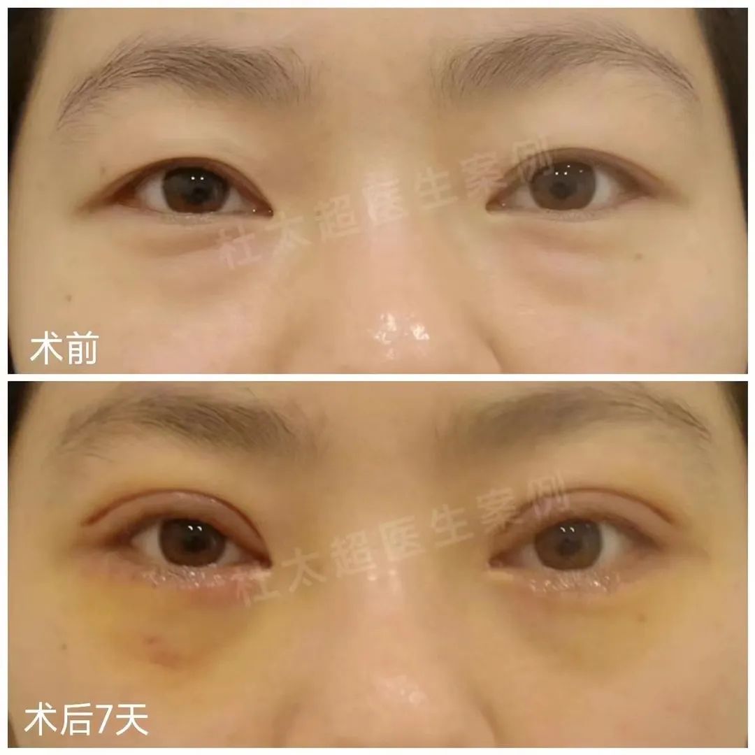 泪沟一出怎样歼灭？