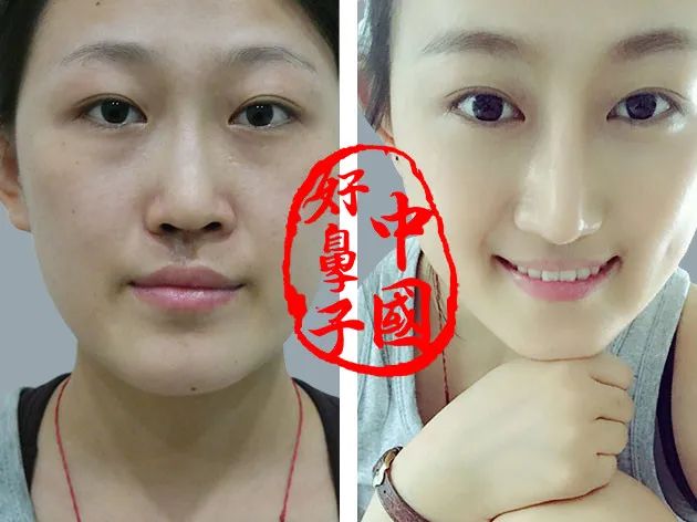 鼻整形失败的原因一定要看！