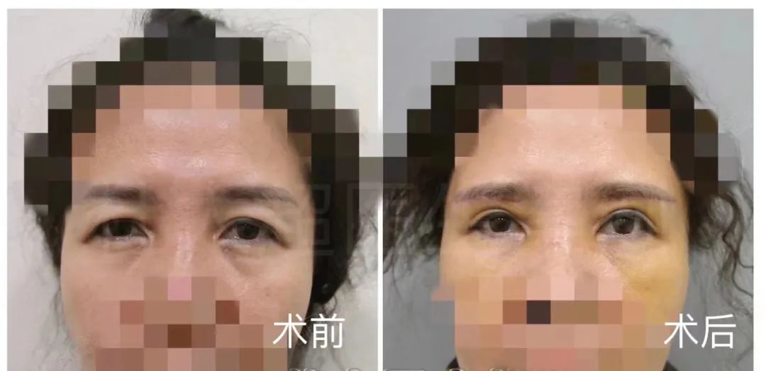 耷拉的眼皮怎么处理? 耷拉的眼皮怎么处理?