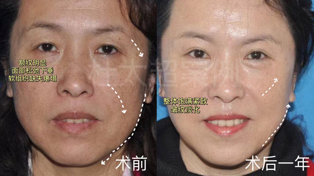 发现这样改善法令纹,超有效! 发现这样改善法令纹,超有效!