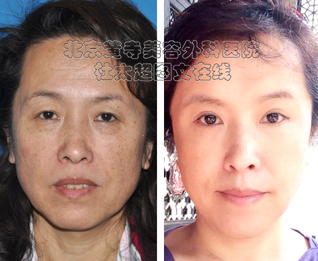 登陆央视12年后,黄寺医美杜太超“小切口拉皮除皱”美誉天下 登陆央视12年后,黄寺医美杜太超“小切口拉皮除皱”美誉天下