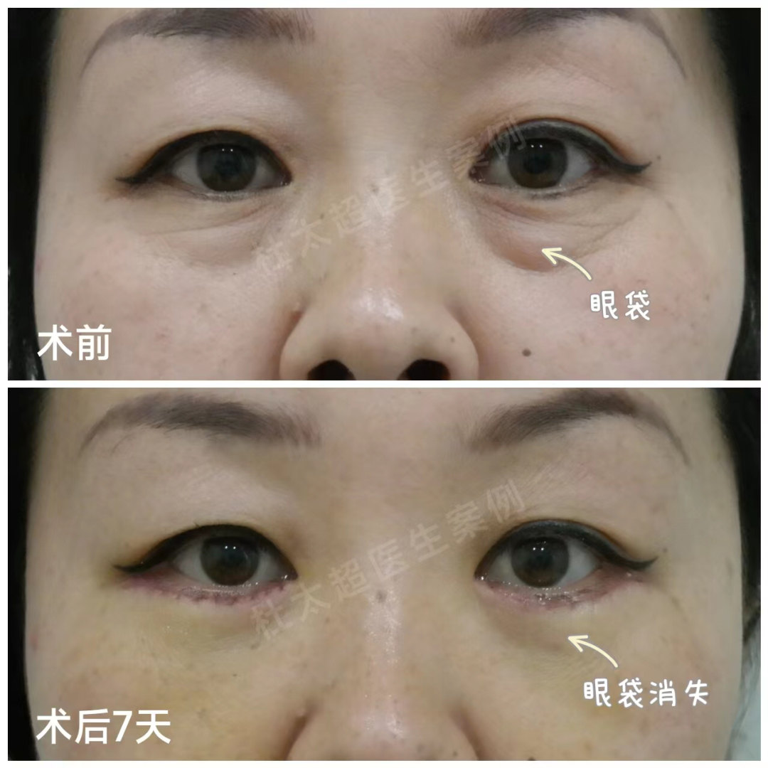 长期眼袋有哪些潜藏危害？