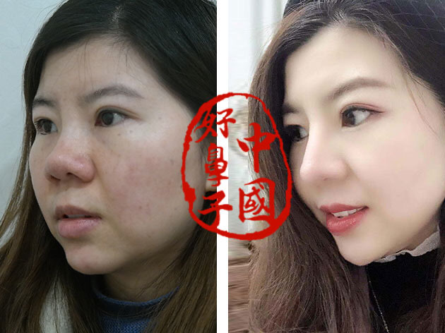 隆鼻的知识点术前你都了解吗？