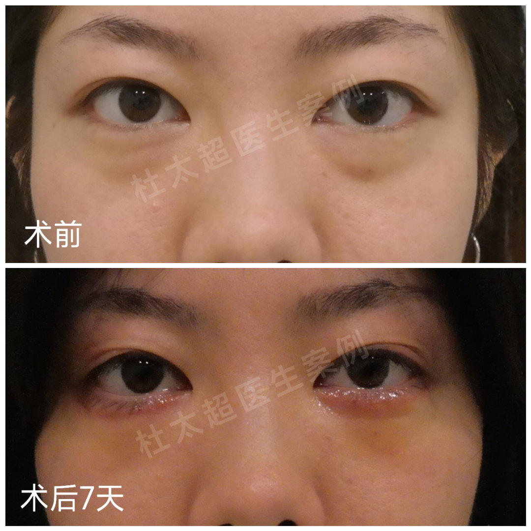 为什么眼袋手术后效果反而更不理想! 为什么眼袋手术后效果反而更不理想!