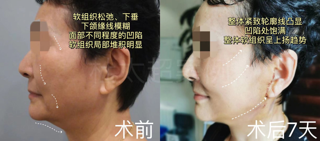 caw小切口拉皮后的常规操作！