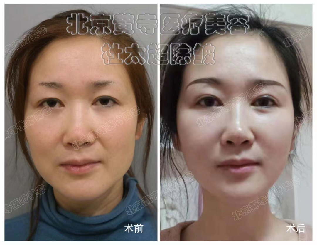 眼皮松弛了这样做...