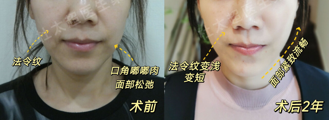 多层次松弛下垂得考虑这样做！