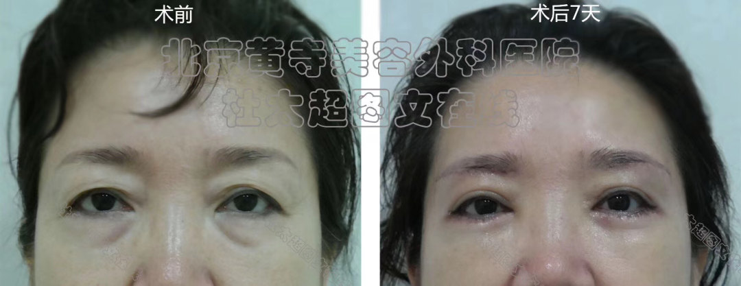 一次祛眼袋手术效果到底可以维持多久? 一次祛眼袋手术效果到底可以维持多久?