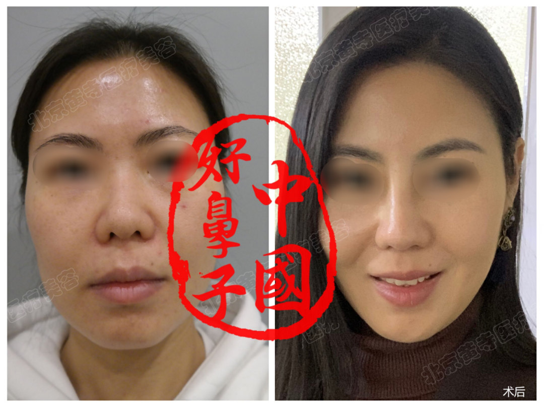 进行鼻翼缩小术，需要遵循哪些原则呢？