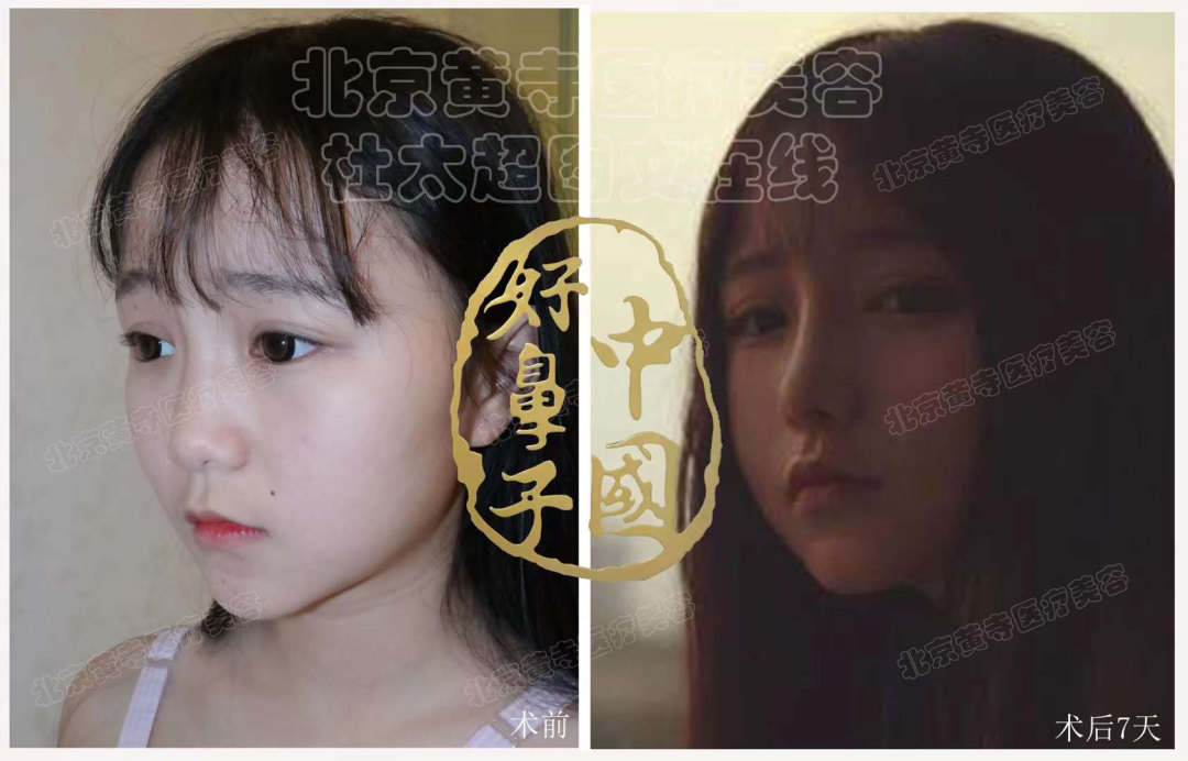 隆鼻后的鼻子真的这么脆弱？