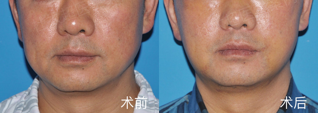 面部松弛提上去就完了吗？