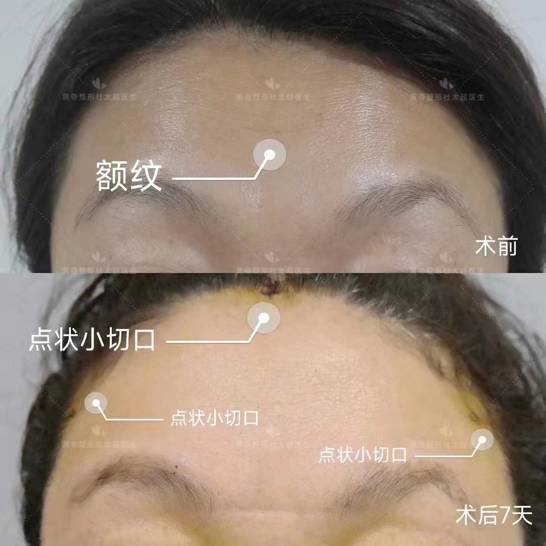 抬头纹可以永久去除吗？