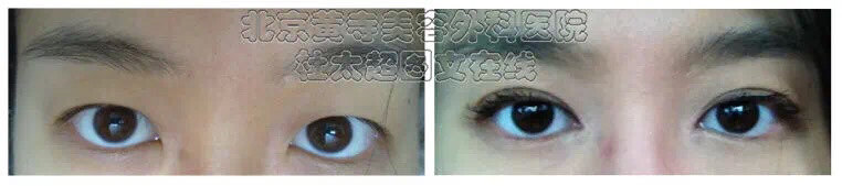 这类人群千万别做双眼皮！