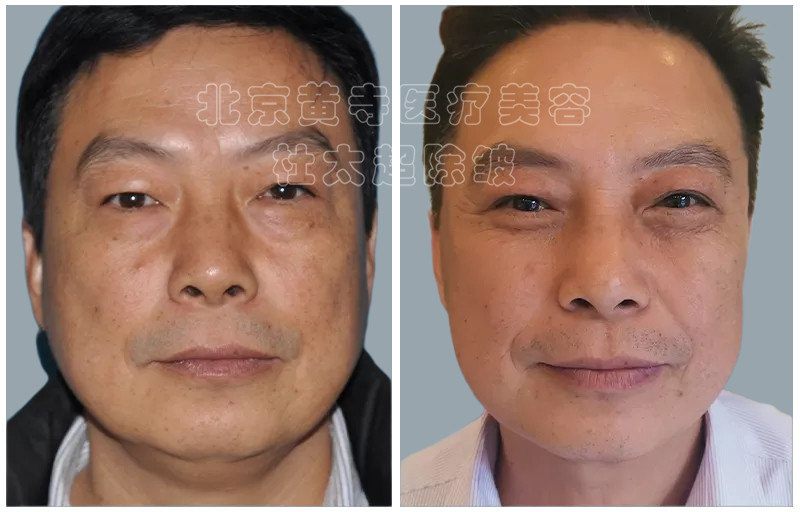眼袋去除术后对比